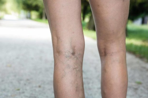 Las venas varicosas de las extremidades inferiores